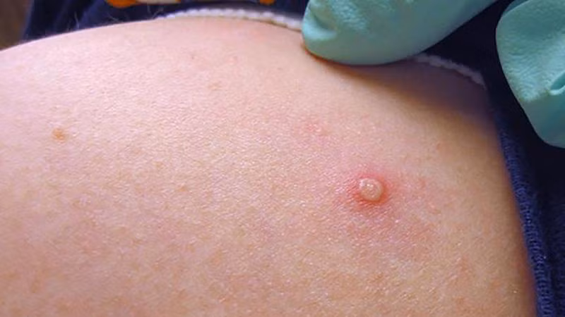 Đậu mùa khỉ hiện đã được ghi nhận ở trên 106 nước ngoài vùng lưu hành bệnh (châu Phi). 