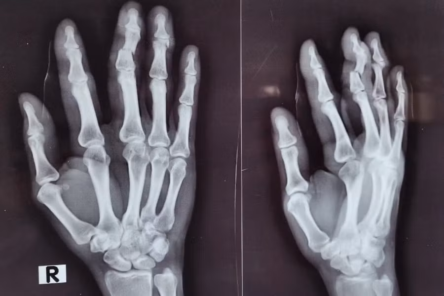 Ảnh chụp X-quang đánh giá các vết thương ở bàn tay của người phụ nữ. Ảnh: BVCC. 