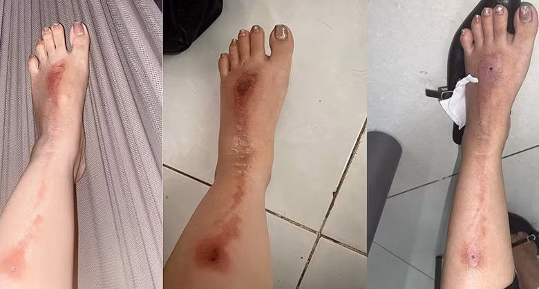 Bệnh nhân A. bị bỏng độ hai, bội nhiễm. Ảnh: BVCC