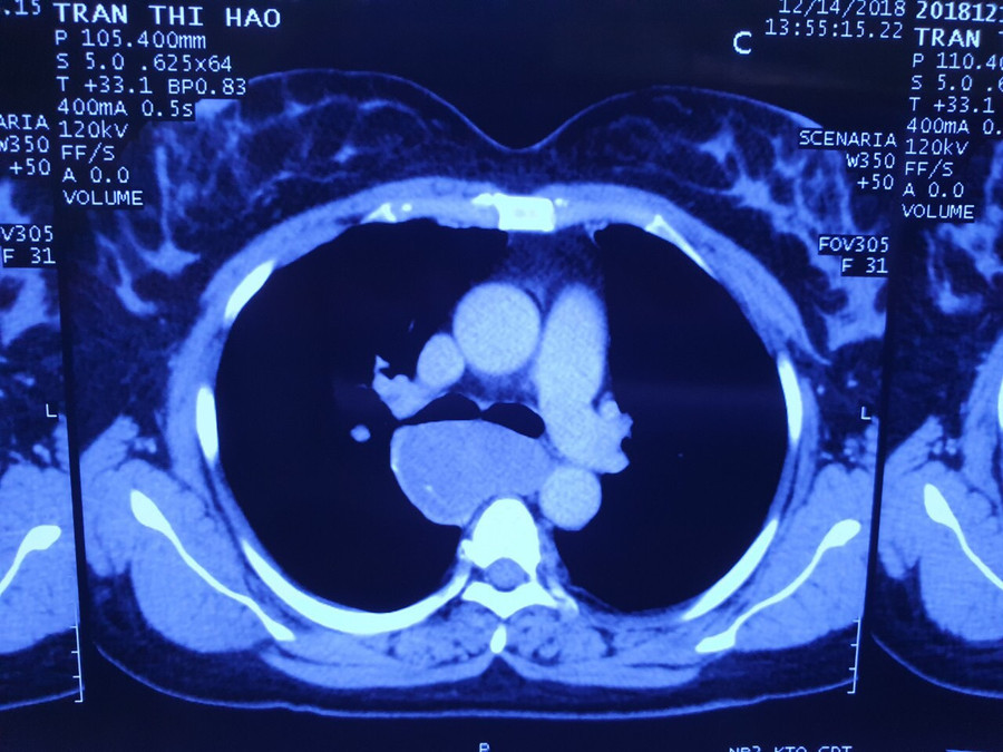 Phim chụp khối u