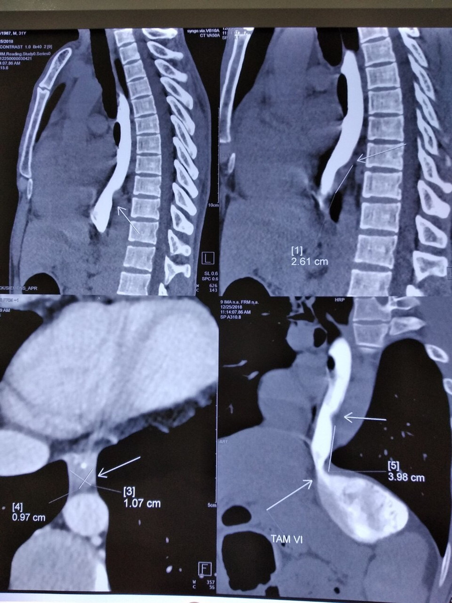 Phim chụp khối u