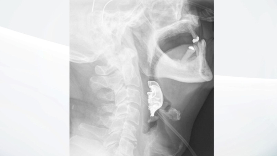 Hình ảnh hàm răng giả nằm trong thanh quản bệnh nhân