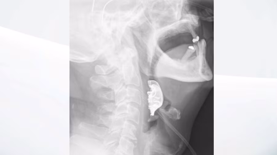 Hình ảnh hàm răng giả nằm trong thanh quản bệnh nhân