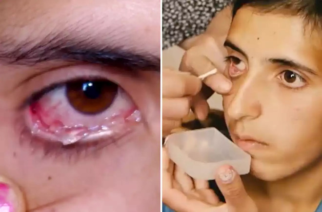 Các chuyên gia nghi ngờ Satenik tự cho thủy tinh vào mắt của mình. Ảnh: Dailymail.