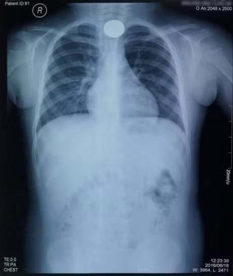 Cuu song be trai 4 tuoi bi bit duong tho vi nuot phai dong xu choi game - Anh 1