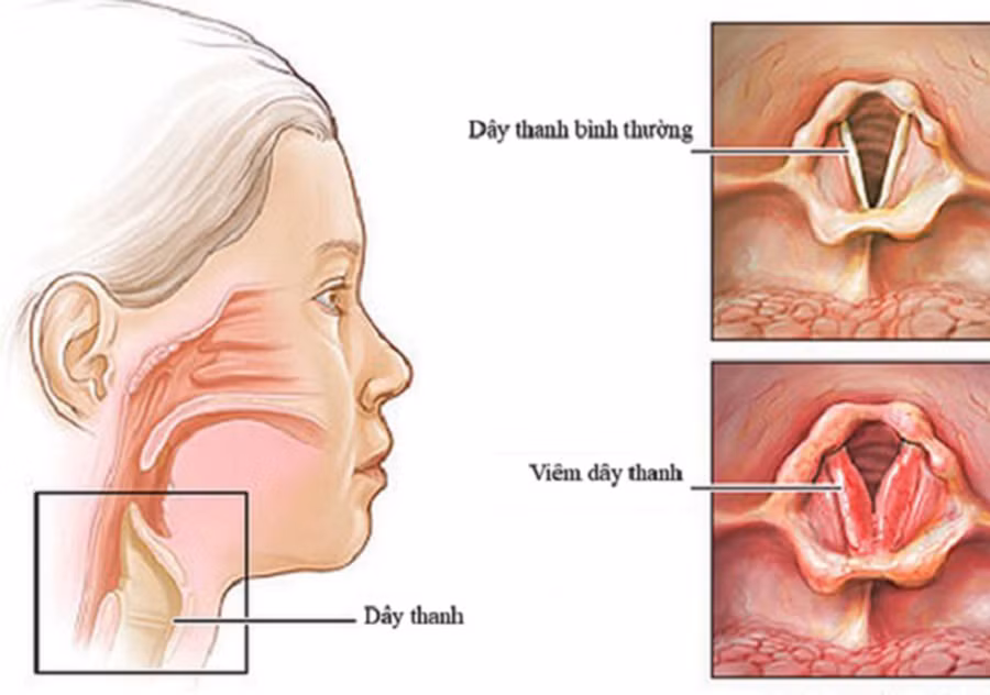 Viêm dây thanh quản có thể dẫn tới mất tiếng và kéo theo nhiều hệ lụy khác.