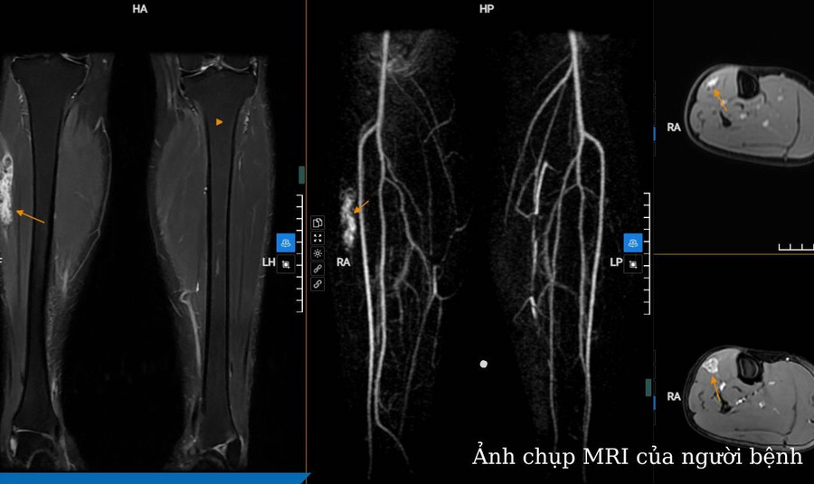 Dựa vào các kết quả, bác sĩ kết luận đây là khối dị dạng mạch máu vị trí 1/3 trên cơ chày trước cẳng chân bên phải. Ảnh: BVCC.