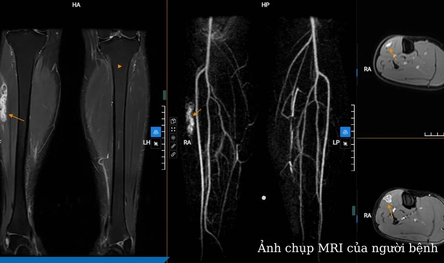 Dựa vào các kết quả, bác sĩ kết luận đây là khối dị dạng mạch máu vị trí 1/3 trên cơ chày trước cẳng chân bên phải. Ảnh: BVCC.