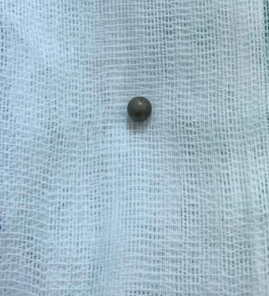 Viên đạn được lấy ra thành công. Ảnh: BV.