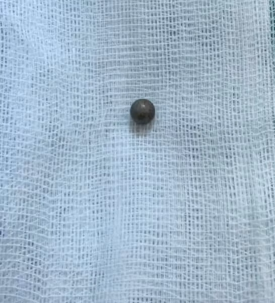 Viên đạn được lấy ra thành công. Ảnh: BV.