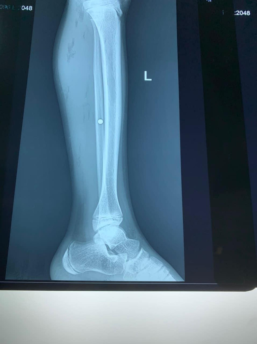 Phim X-quang cho thấy viên đạn nằm ở cẳng chân bệnh nhi. Ảnh: BV.