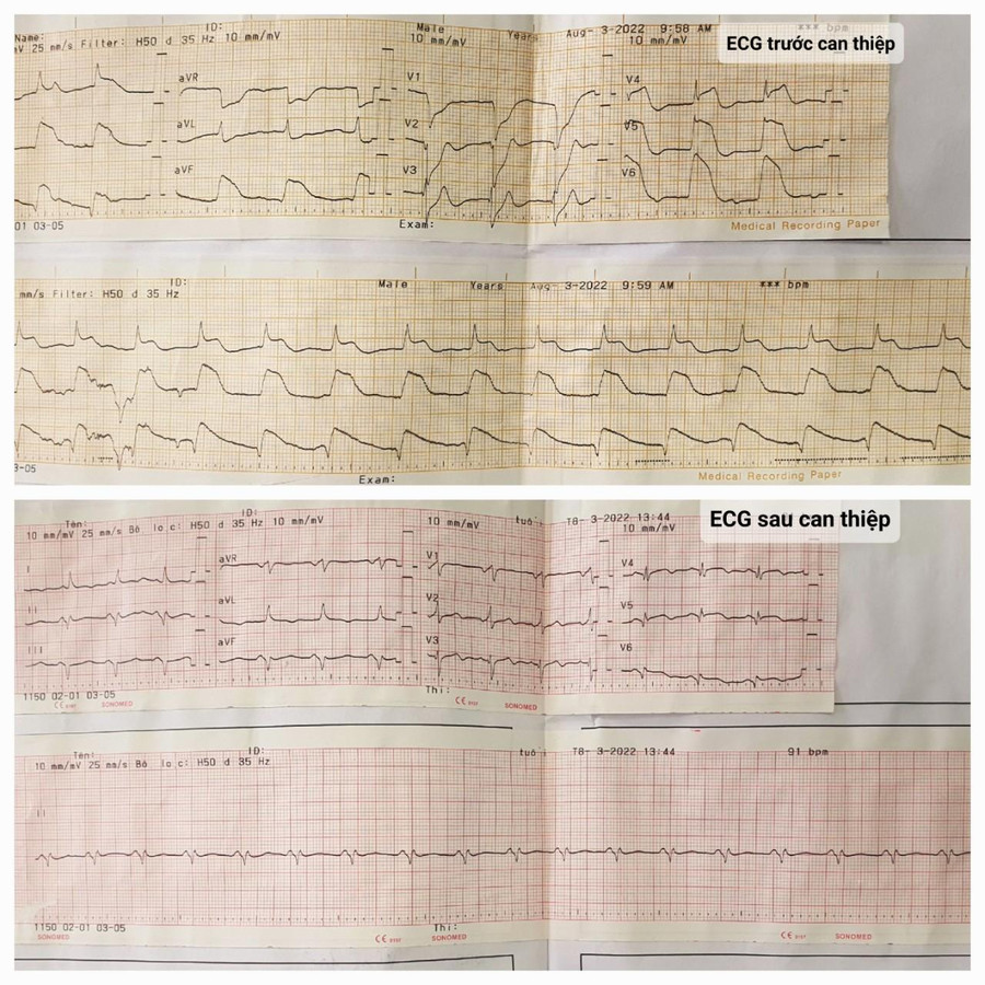 Hình ảnh biến đổi điện tim trước và sau can thiệp động mạch vành. Ảnh: BV. Hình ảnh biến đổi điện tim trước và sau can thiệp động mạch vành. Ảnh: BV.