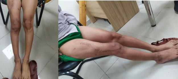 Đôi chân bệnh nhân sau phẫu thuật thành công. Ảnh: BV. Đôi chân bệnh nhân sau phẫu thuật thành công. Ảnh: BV.