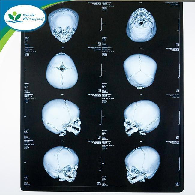 Hình ảnh phim chụp của bệnh nhi. Ảnh: BV. Hình ảnh phim chụp của bệnh nhi. Ảnh: BV.