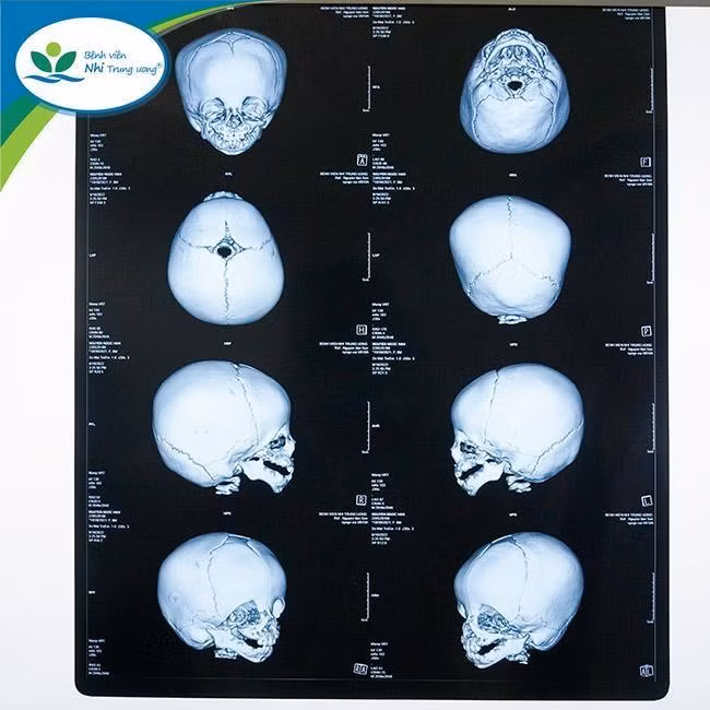 Hình ảnh phim chụp của bệnh nhi. Ảnh: BV. Hình ảnh phim chụp của bệnh nhi. Ảnh: BV.