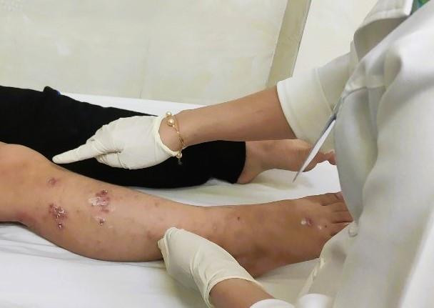 Chốc lở là một chứng bệnh da hay gặp khi điều kiện vệ sinh sau mưa bão kém. Ảnh minh họa. Chốc lở là một chứng bệnh da hay gặp khi điều kiện vệ sinh sau mưa bão kém. Ảnh minh họa.