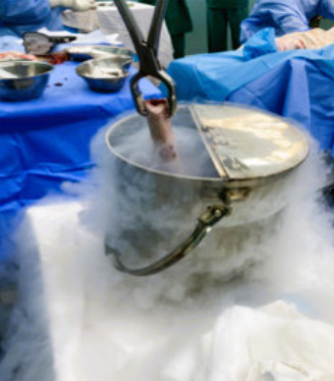 Khối xương được ngâm trong dung dịch Ni-tơ bảo quản lạnh 20 phút. Ảnh: BV. Khối xương được ngâm trong dung dịch Ni-tơ bảo quản lạnh 20 phút. Ảnh: BV.