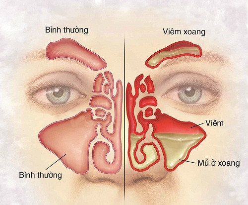 Chữa viêm xoang bằng cây cứt lợn ảnh 2 Chữa viêm xoang bằng cây cứt lợn