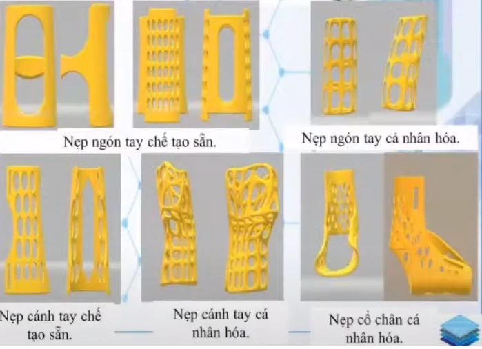 Nẹp chấn thương chỉnh hình bằng công nghệ in 3D mà nhóm nghiên cứu đã hoàn thiện.