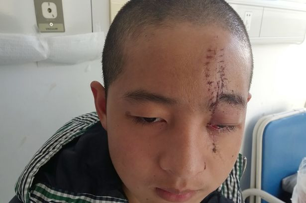 Thoát chết kỳ diệu dù bị cưa cắm vào đầu - Ảnh 3 Thoát chết kỳ diệu dù bị cưa cắm vào đầu - Ảnh 3