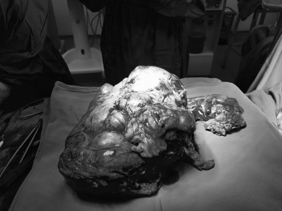 Khối u mạc treo được loại bỏ