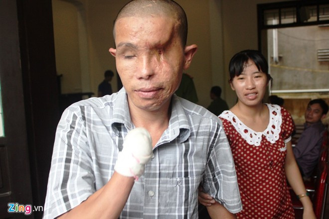 Anh Hảo là người bị thương tật nặng nhất, tổn thất đến 98% sức khỏe. Anh được người vợ đưa đến dự tòa. Ảnh: P.H. Anh Hảo là người bị thương tật nặng nhất, tổn thất đến 98% sức khỏe. Ảnh: P.H.