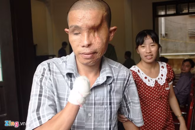 Anh Hảo là người bị thương tật nặng nhất, tổn thất đến 98% sức khỏe. Ảnh: P.H.