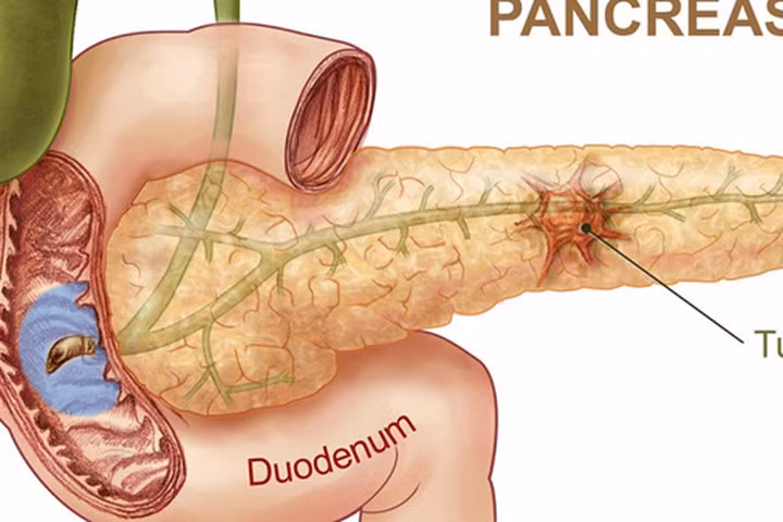 Đột phá trong nghiên cứu điều trị ung thư tuyến tụy