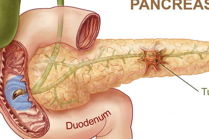 Đột phá trong nghiên cứu điều trị ung thư tuyến tụy