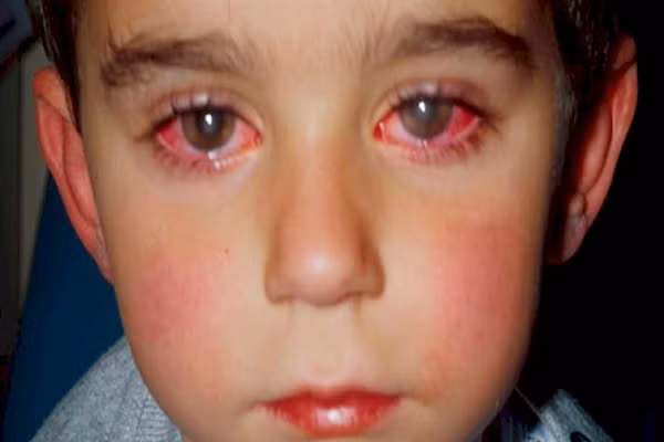 Những loại đồ chơi có thể khiến trẻ bị mù vĩnh viễn