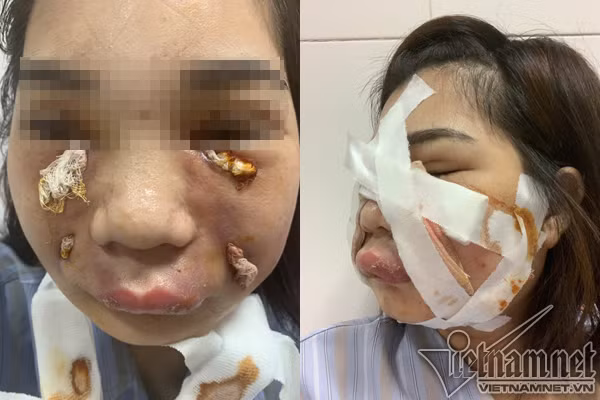 Cô gái xinh đẹp phải rạch mặt để nặn mủ do tiêm mỡ tự thân làm đẹp