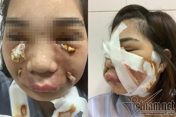 Cô gái xinh đẹp phải rạch mặt để nặn mủ do tiêm mỡ tự thân làm đẹp Cô gái xinh đẹp phải rạch mặt để nặn mủ do tiêm mỡ tự thân làm đẹp