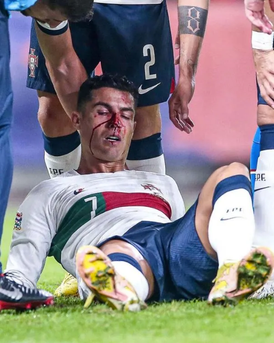 Ronaldo đổ máu sau khi va chạm với thủ môn CH Czech. Ronaldo đổ máu sau khi va chạm với thủ môn CH Czech.