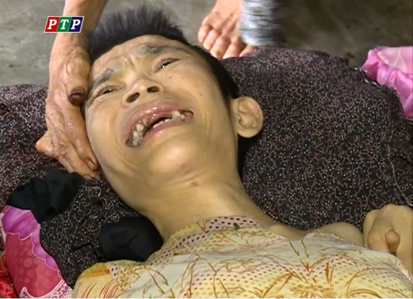 Hai người con tật nguyền vì di chứng chất độc màu da cam của cụ Gương1 Hai người con tật nguyền vì di chứng chất độc màu da cam của cụ Gương