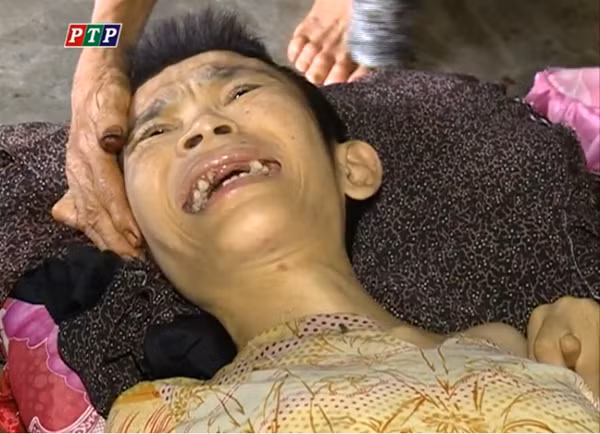 Hai người con tật nguyền vì di chứng chất độc màu da cam của cụ Gương