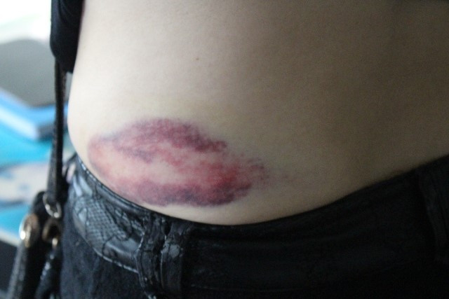 Vết bầm tìm ở hông trái mà chị Na khẳng định bị anh Tuấn đánh. Ảnh: Trần Tuấn Vết bầm tìm ở hông trái mà chị Na khẳng định bị anh Tuấn đánh. Ảnh: Trần Tuấn