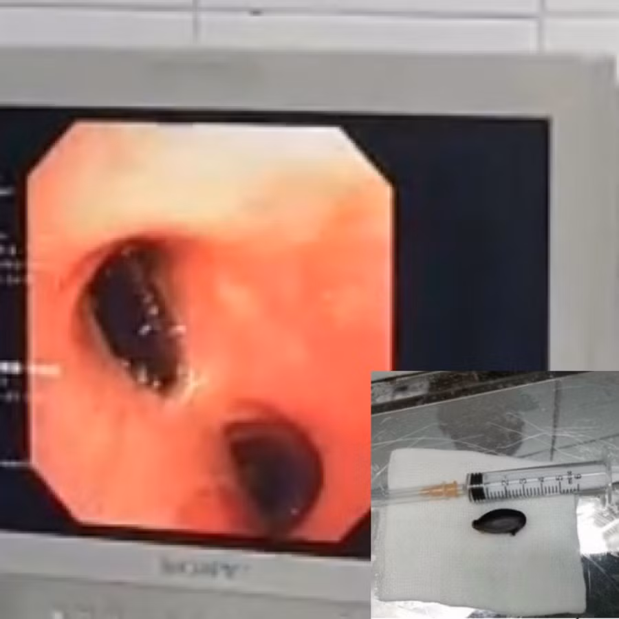 Hình ảnh nội soi dị vật là hạt hồng xiêm. Ảnh: BV.