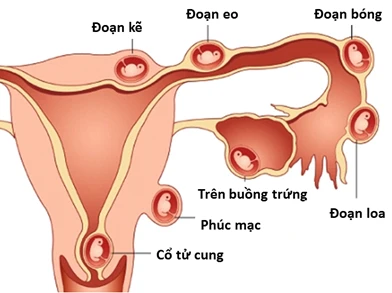 Ảnh minh họa: ITN