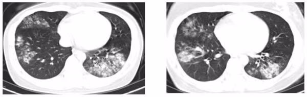 Phim chụp cắt lớp điển hình của bệnh nhân mắc viêm phổi cộng đồng. Ảnh: BVCC