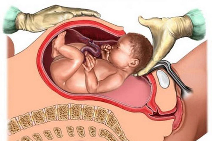 Những trường hợp mẹ bầu cần sinh mổ