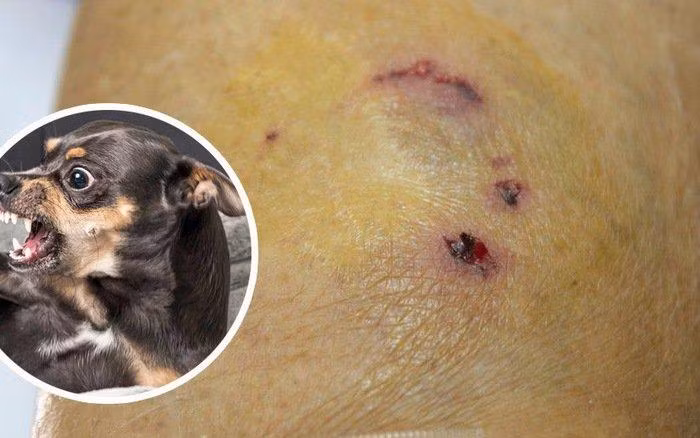 Tiêm phòng dại ngay sau khi bị chó cắn là biện pháp bảo vệ hiệu quả nhất.