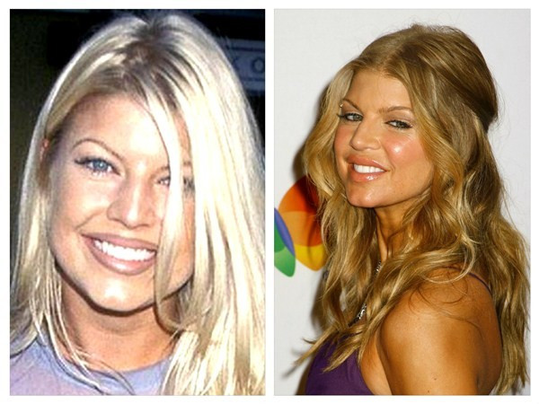 Fergie cũng là con nghiện của việc bơm môi, má, độn cằm. Fergie