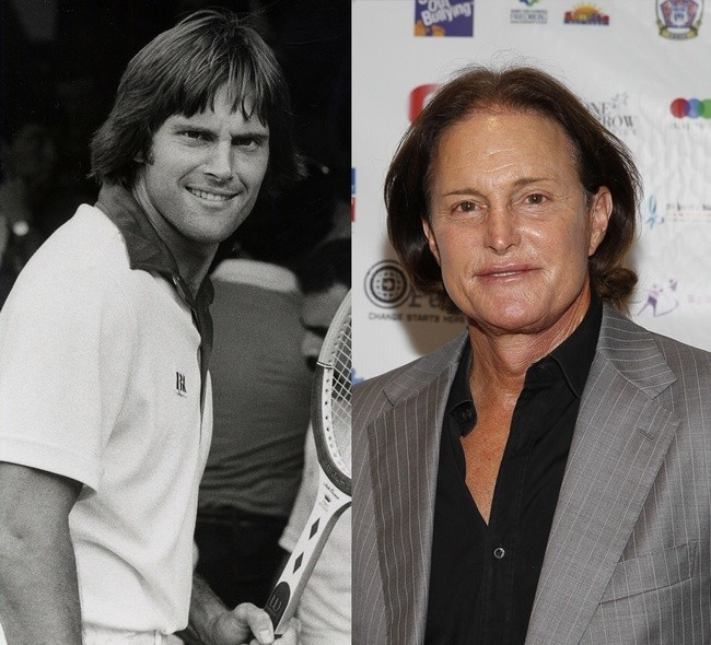 Cựu vận động viên Bruce Jenner cũng là con nghiện của dao kéo. Bruce Jenner