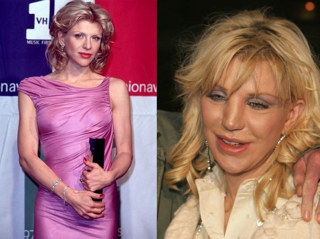 Courtney Love cũng sở hữu gương mặt sập xệ vì dao kéo quá đà. Courtney Love