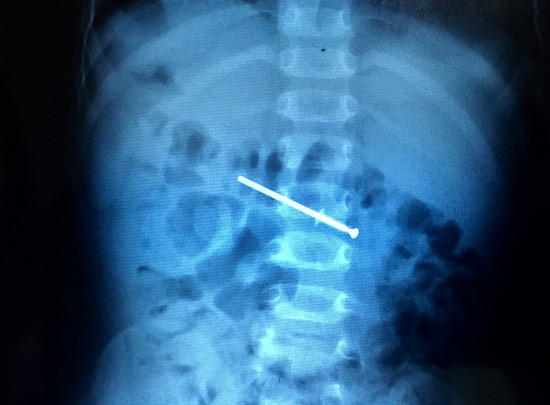 Cây đinh được nhìn thấy qua phim X-quang. Ảnh: Thiên Chương cay-dinh-dai-5-cm-chui-vao-ruot-non-be-trai