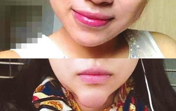5 biến chứng phẫu thuật thẩm mỹ đáng sợ nhất năm 2015 hình ảnh 4 5 bien chung phau thuat tham my dang so nhat nam 2015 hinh anh 4