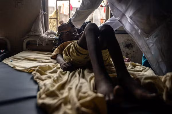 SCD gây thiếu máu, mệt mỏi và đau đớn khủng khiếp.