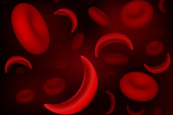 Hồng cầu hình liềm. Hồng cầu hình liềm.