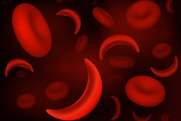 Hồng cầu hình liềm.
