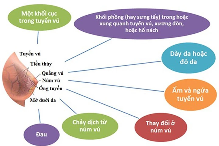 Hãy cẩn trọng với những triệu chứng của bệnh ung thư vú